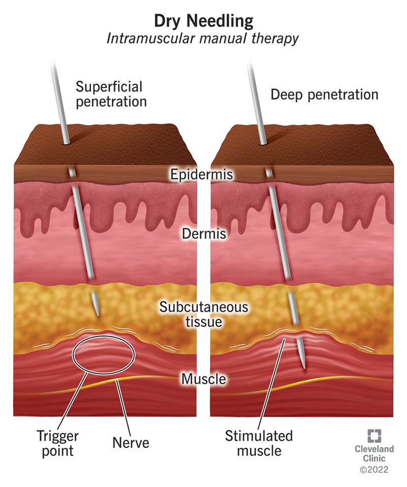 Dry Needling